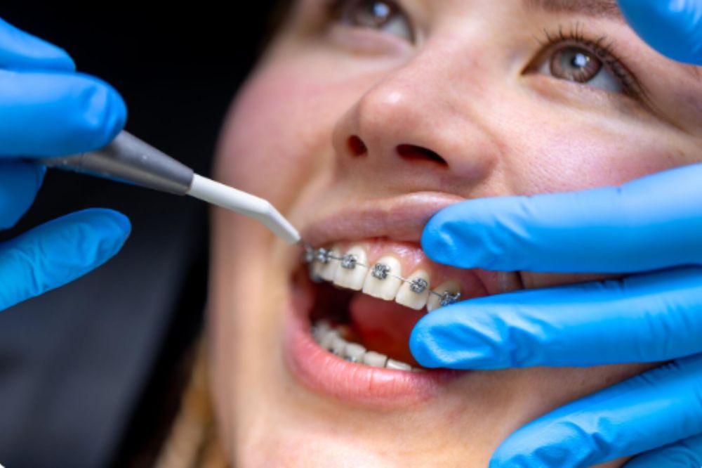 Why Adults Are Turning To Orthodontics Through Their General Dentist